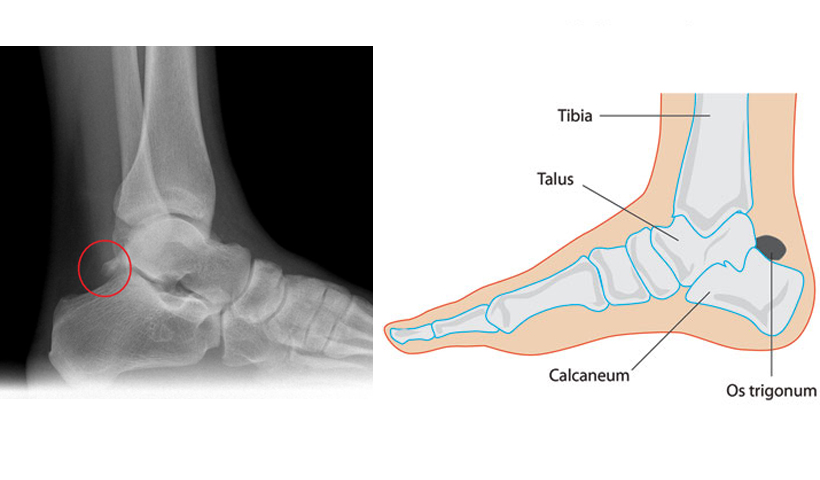 Diabetic Foot Problems – Pictures, Causes, Symptoms, Treatment