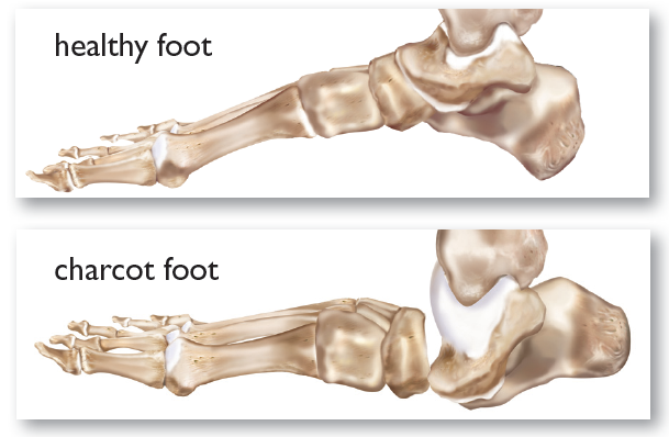 Healthy foot vs charcot foot diagram