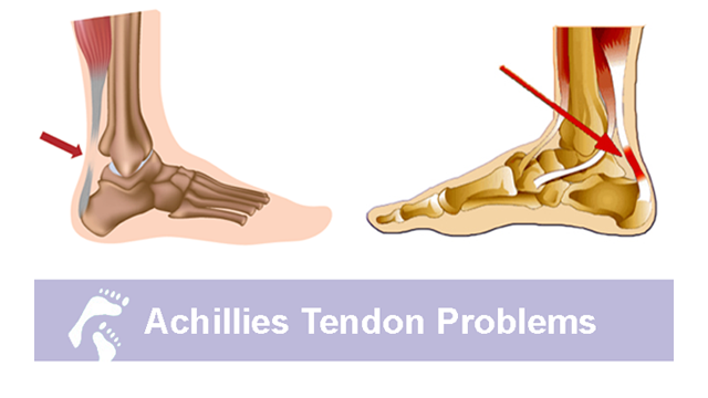 Achilles Tendon Problems | Country Foot Care