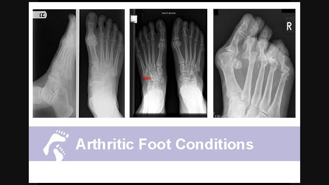 Was sind arthritische Fußerkrankungen ;Was Country Foot Care Ärzte über Arthritis sagen