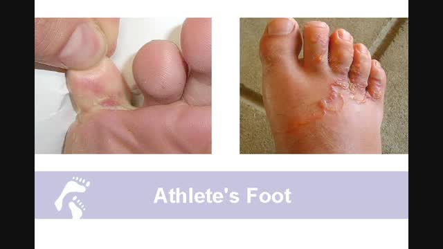 heel athlete's foot