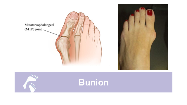 What is a Bunion;How Country Foot Care doctors treat bunions