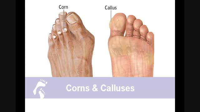 What are Corns and Calluses ;How Country Foot Care doctors treat Corns and Calluses