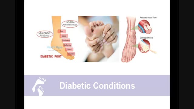 How Diabetes affects your feet;What our doctors say about diabetic foot care