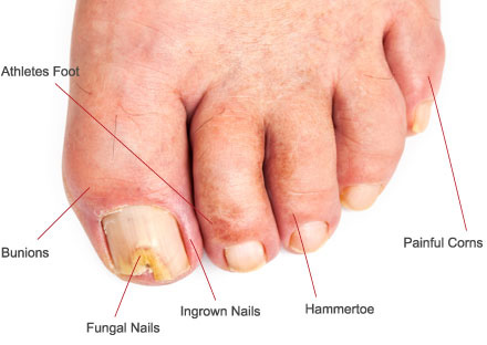 Common Foot and Ankle Conditions