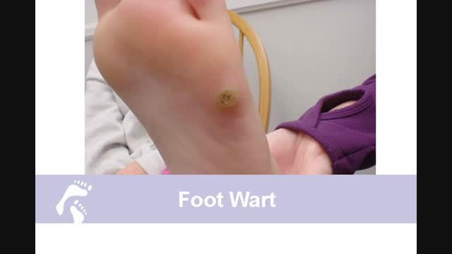 Warts: Spotty Skin Growth Treatment Long Island | Country Foot Care