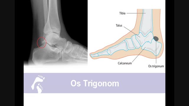 extra bone growth in foot