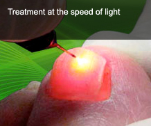 PinPointe FootLaser for Toenail Fungus