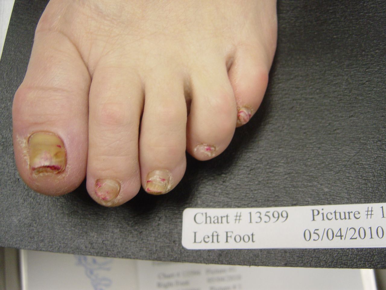 fungal nail before laser treatment