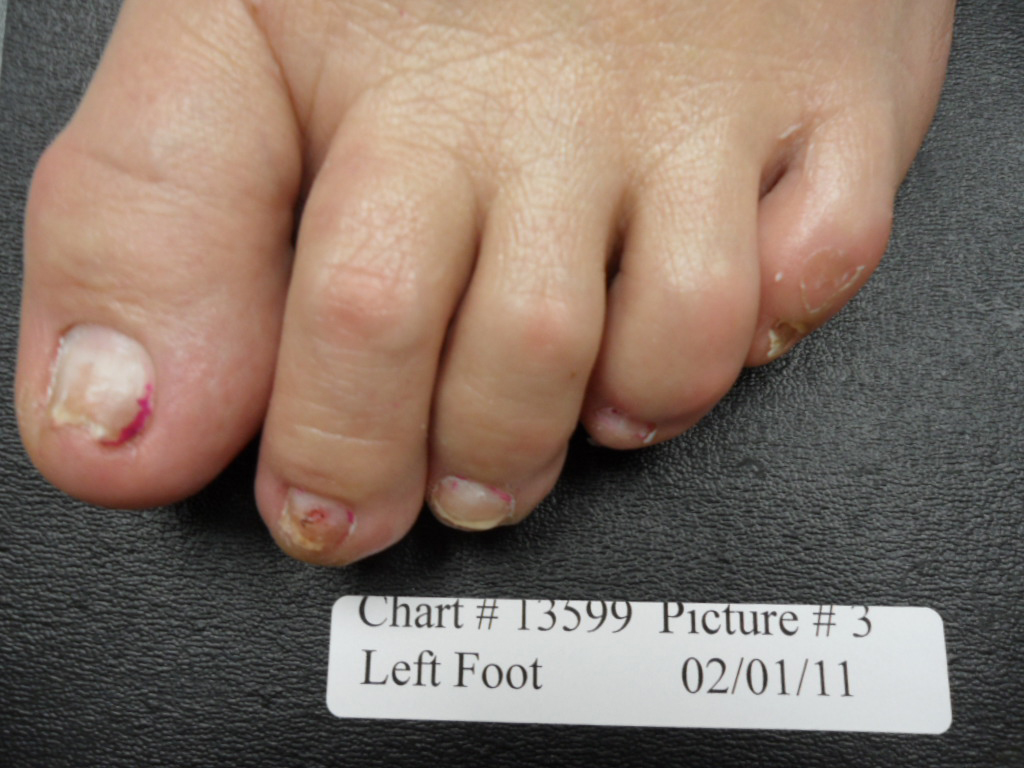 fungal nail after laser treatment