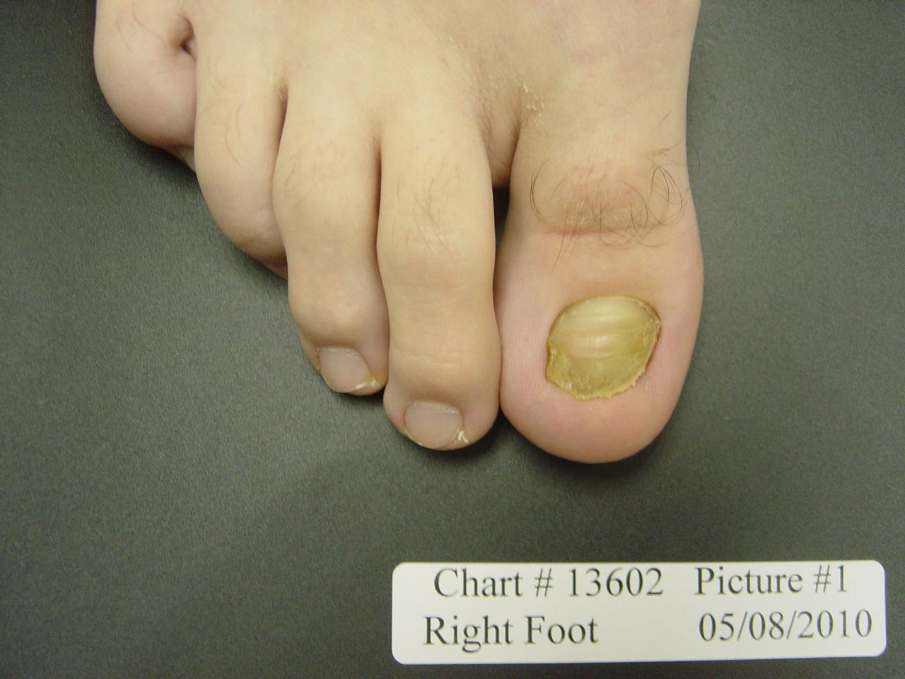 fungal nail before laser treatment