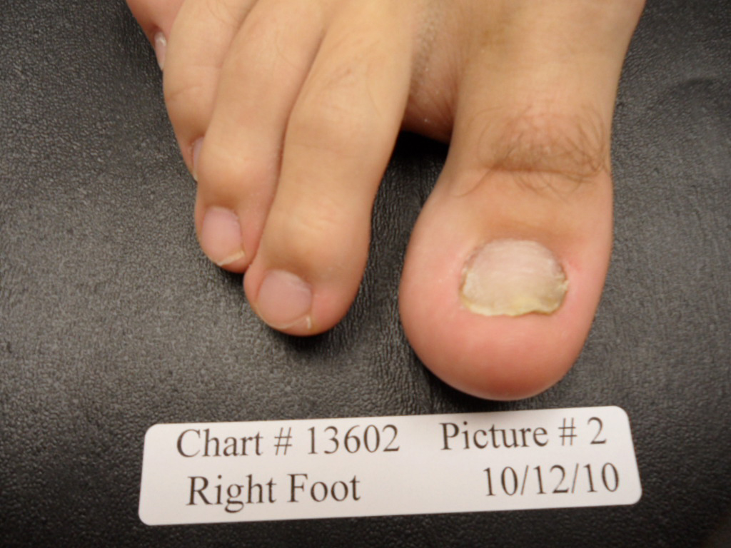 fungal nail after laser treatment