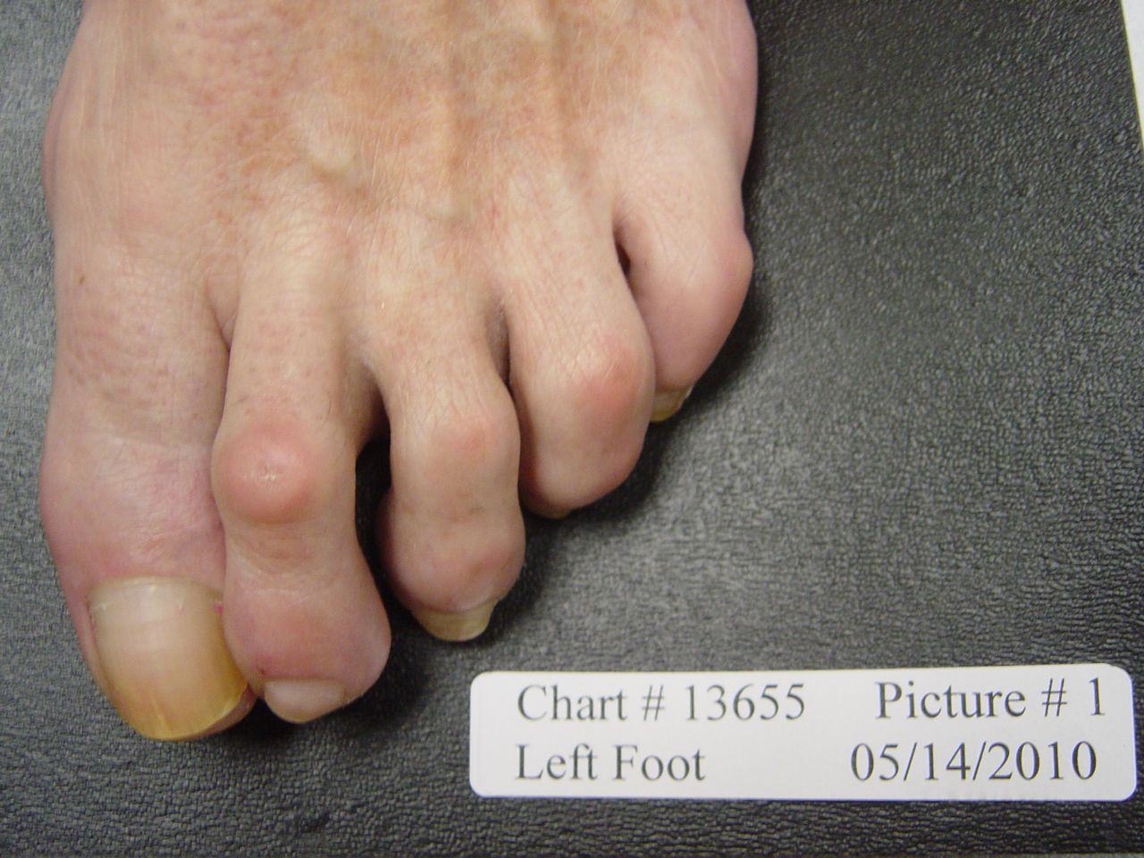 fungal nail before laser treatment