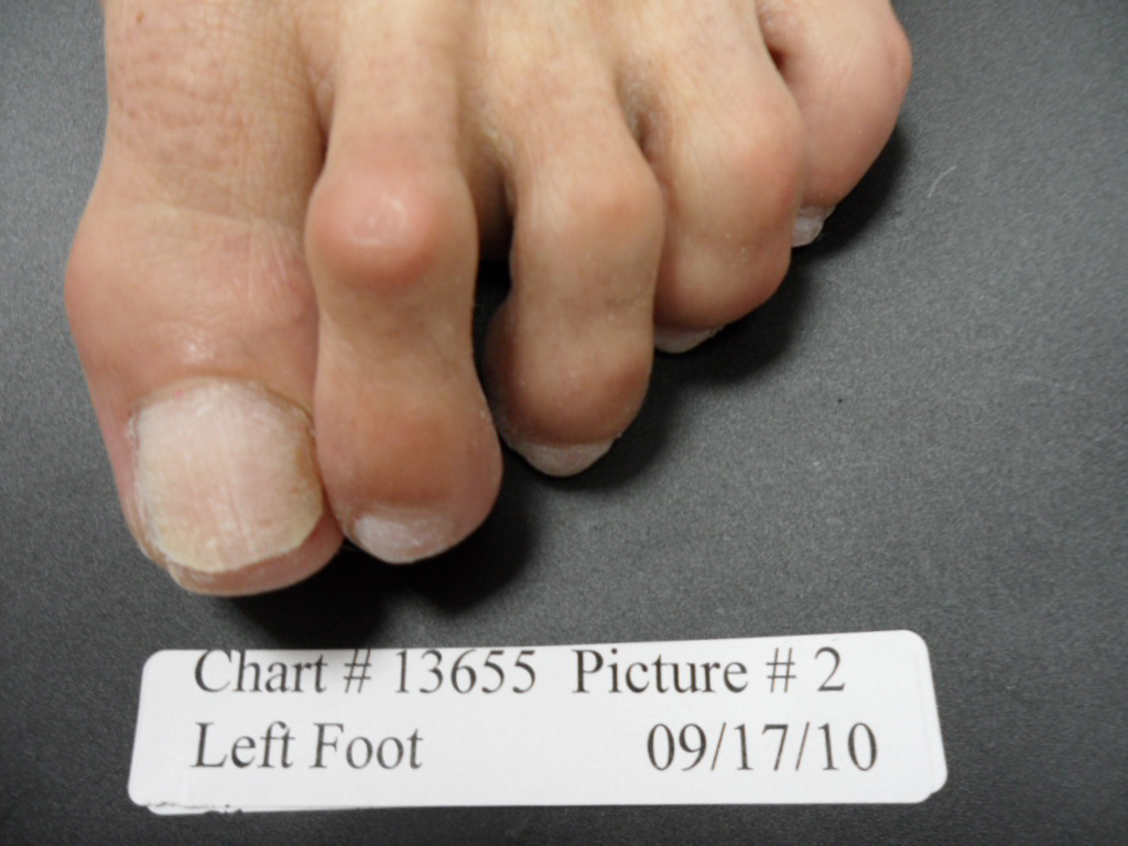 fungal nail after laser treatment