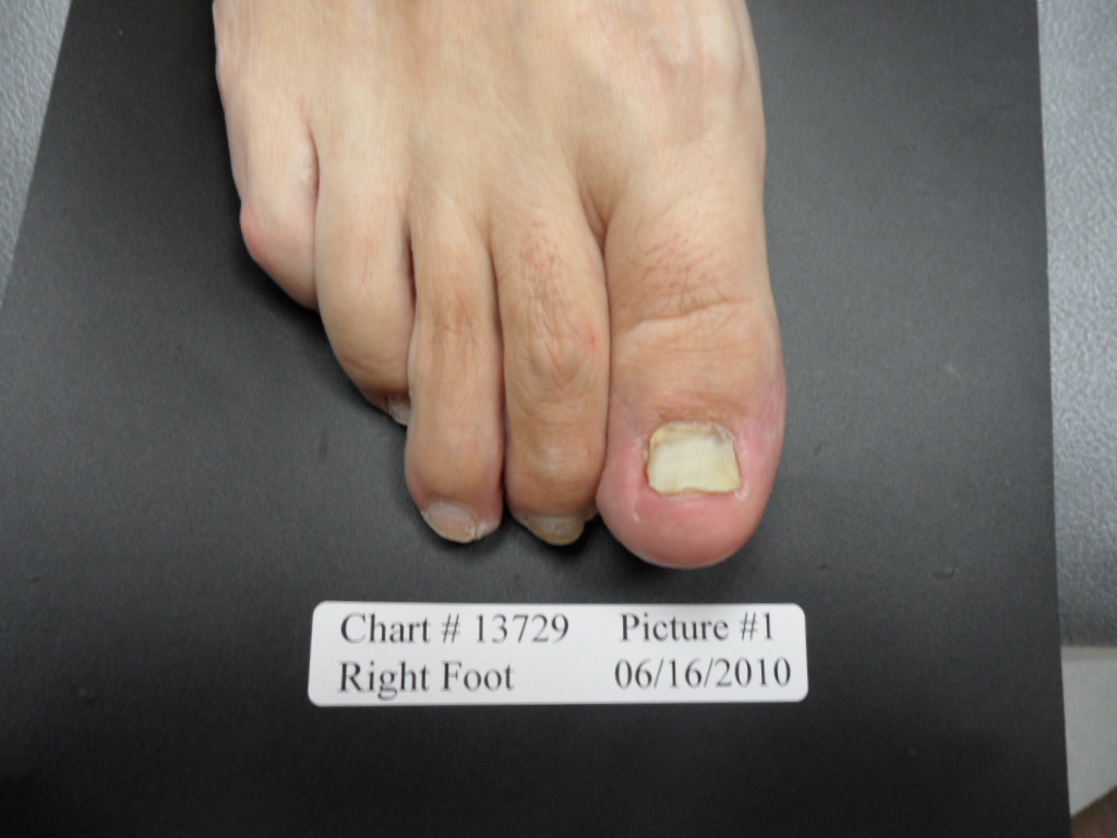 fungal nail before laser treatment