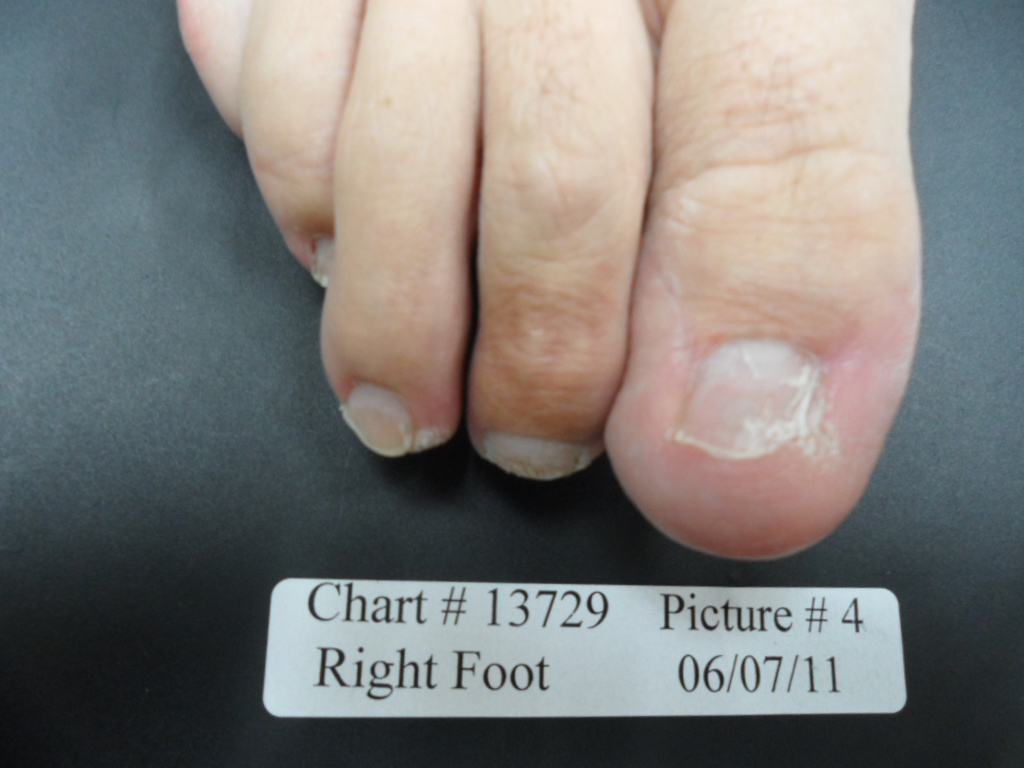 fungal nail after laser treatment