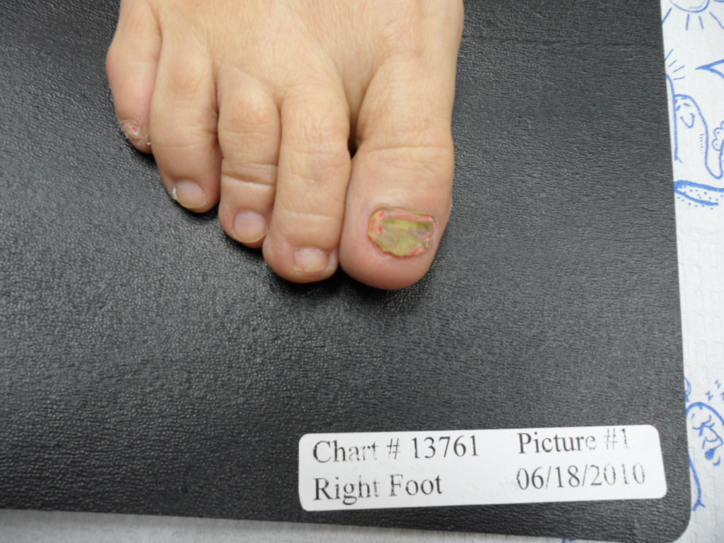 fungal nail before laser treatment