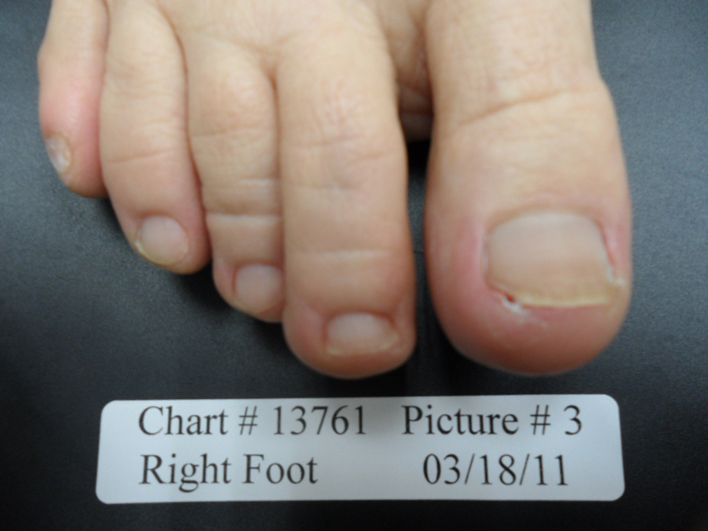 fungal nail after laser treatment