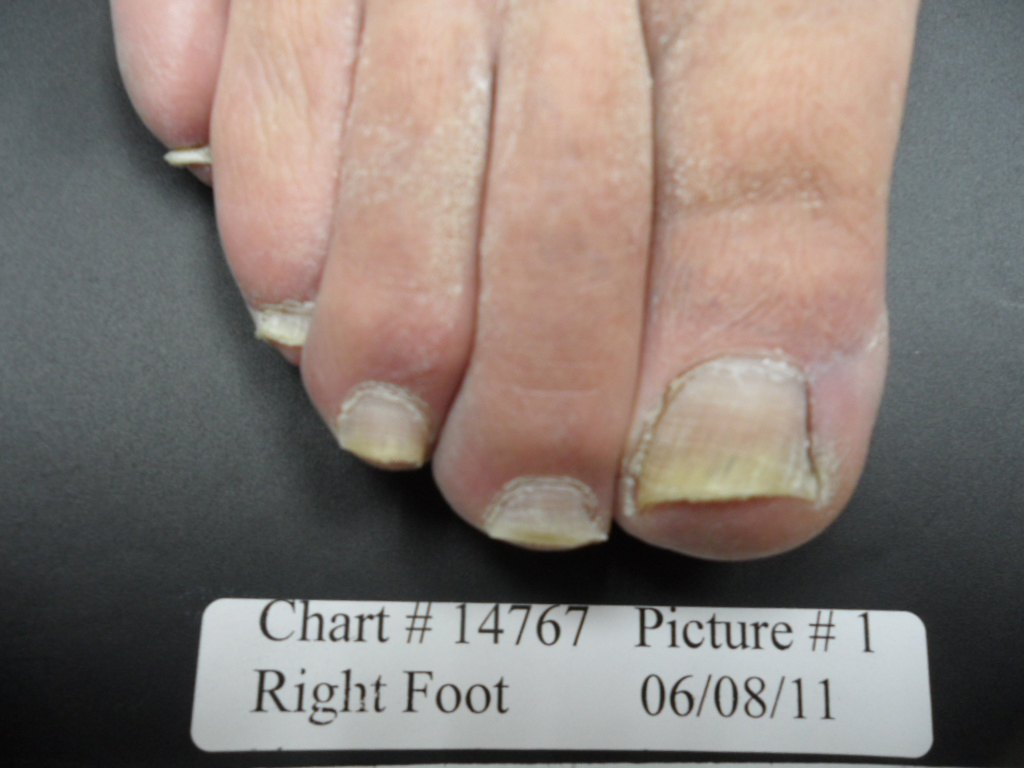 Fungal Nail Patient - 14767 before