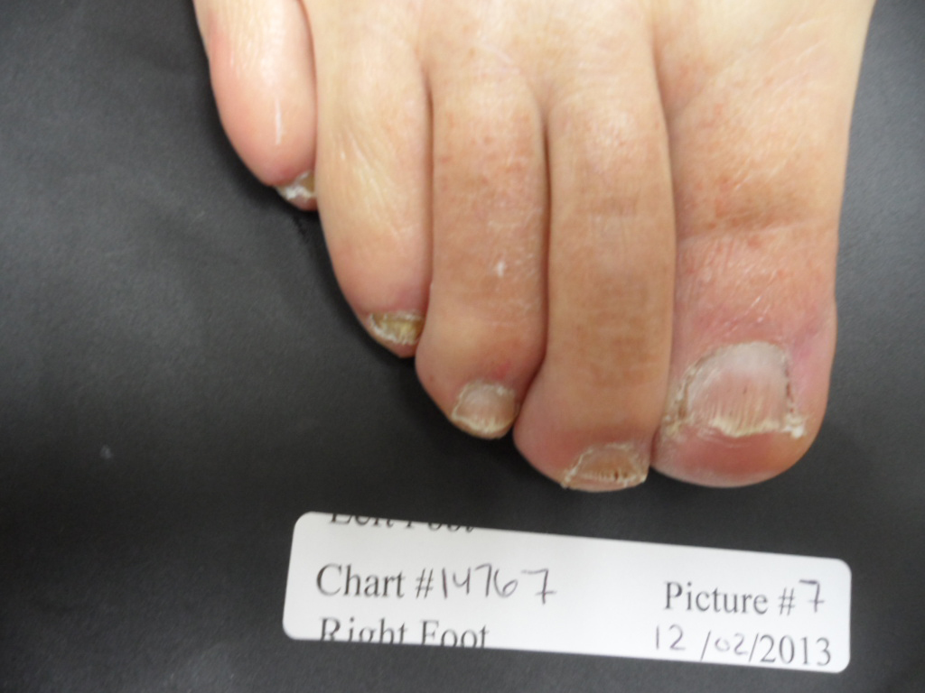 Fungal Nail Patient - 14767 after