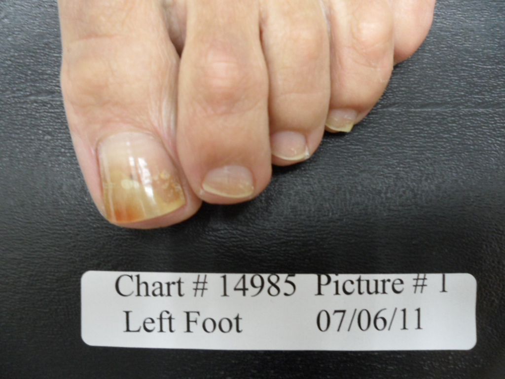 FUNGAL NAIL PATIENT – 14985 before