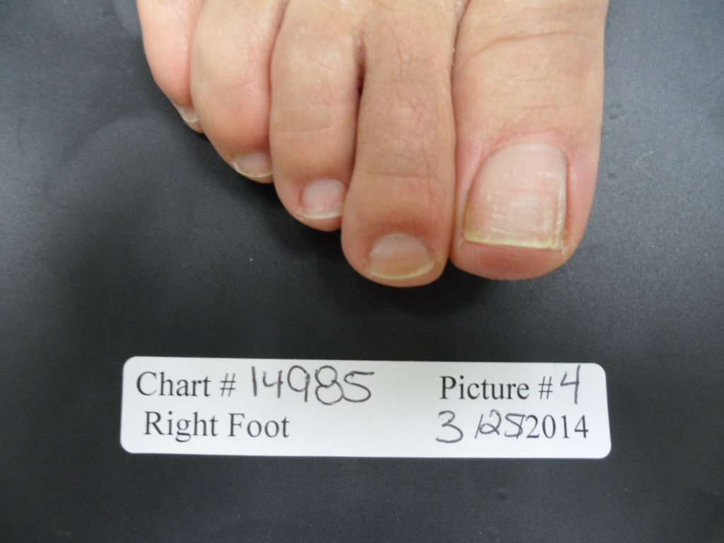 FUNGAL NAIL PATIENT – 14985 after