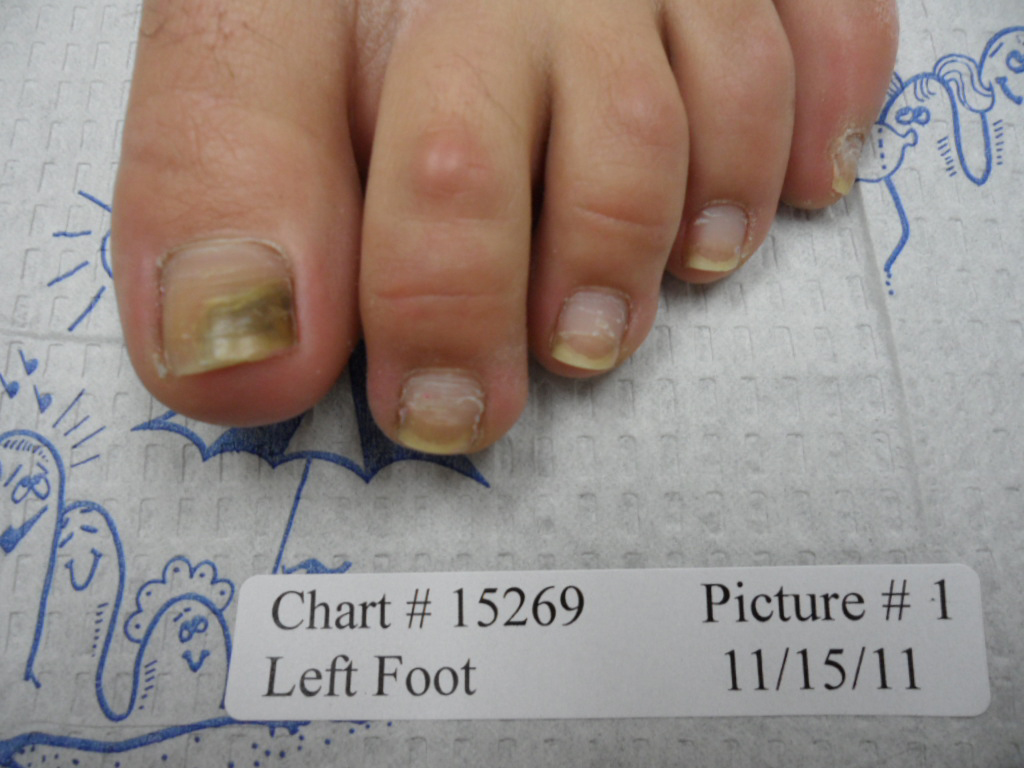 Fungal Nail Patient - 15269 before