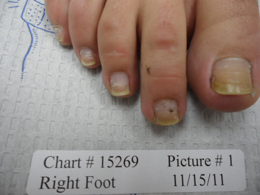 fungal nail before laser treatment