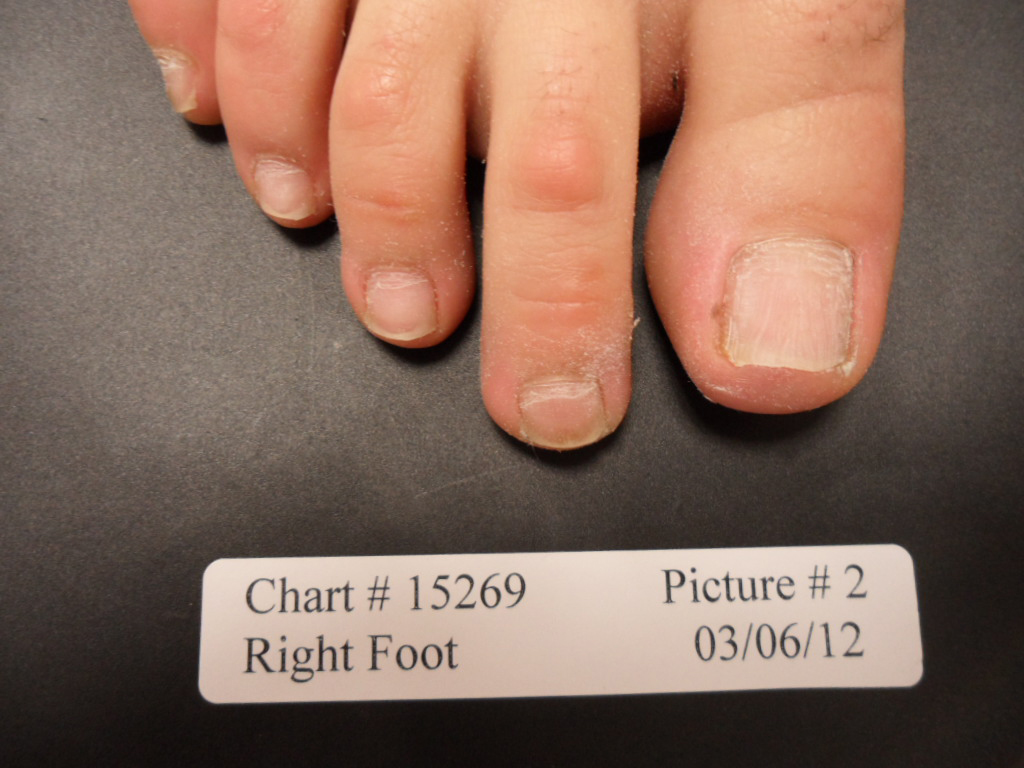 Fungal Nail Patient - 15269 right foot after