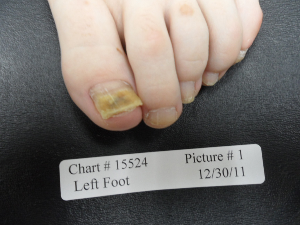 fungal nail before laser treatment