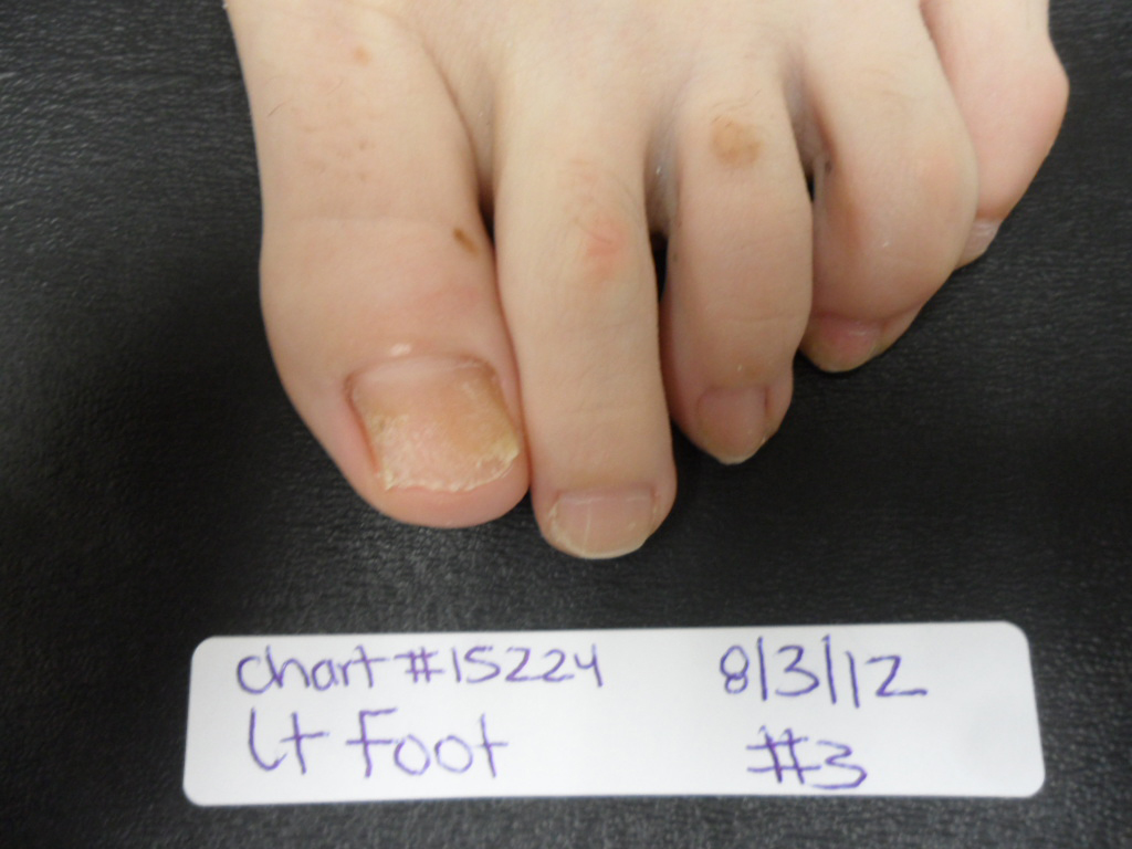 FUNGAL NAIL PATIENT – 15224 after 