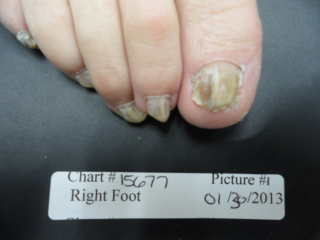 Fungal Nail Patient - 15677 before