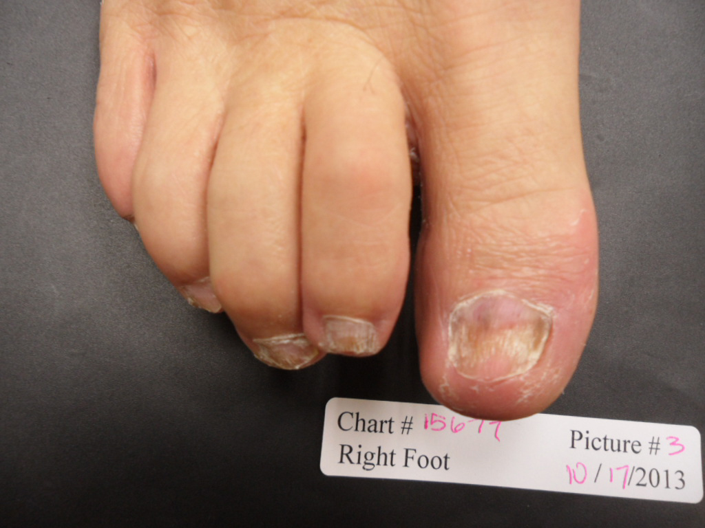 Fungal Nail Patient - 15677 after 