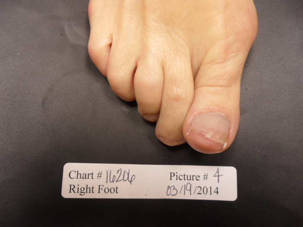 fungal nail after laser treatment