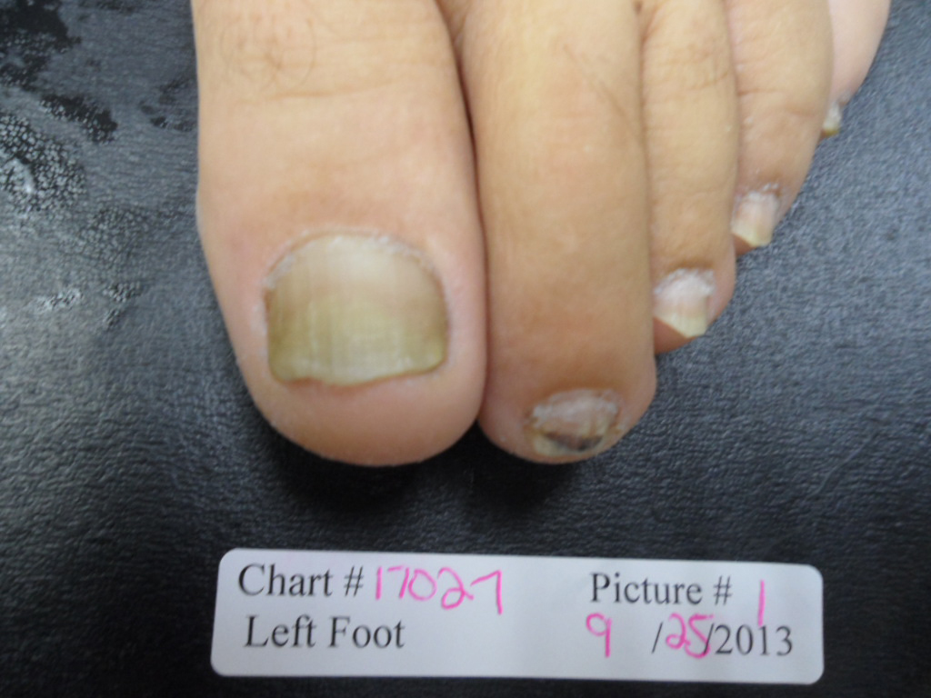 Fungal Nail Patient - 17027 before