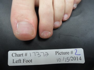 Fungal Nail Patient - 17372 after