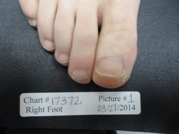 Fungal Nail Patient - 17372 after - right foot