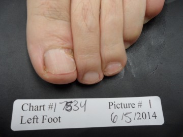 Fungal Nail Patient - 17534 before