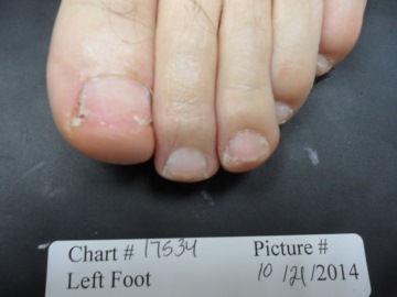 Fungal Nail Patient - 17534 after