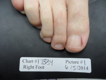 Fungal Nail Patient - 17534 before