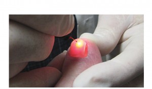 Patient getting laser treatment on toenail fungus from Nassau County podiatrist on Long Island