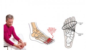 foot diagram showing metatarsalgia