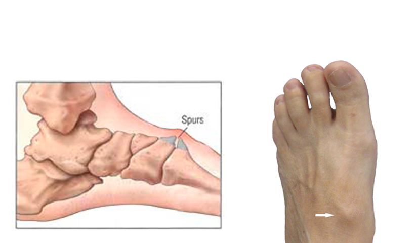 bone spur foot symptoms