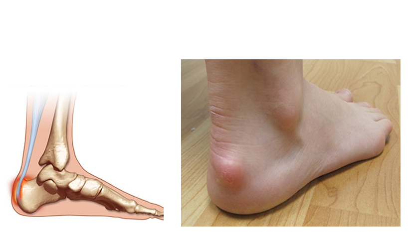 Haglund's Deformity | Country Foot Care