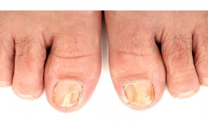 fungal toenails
