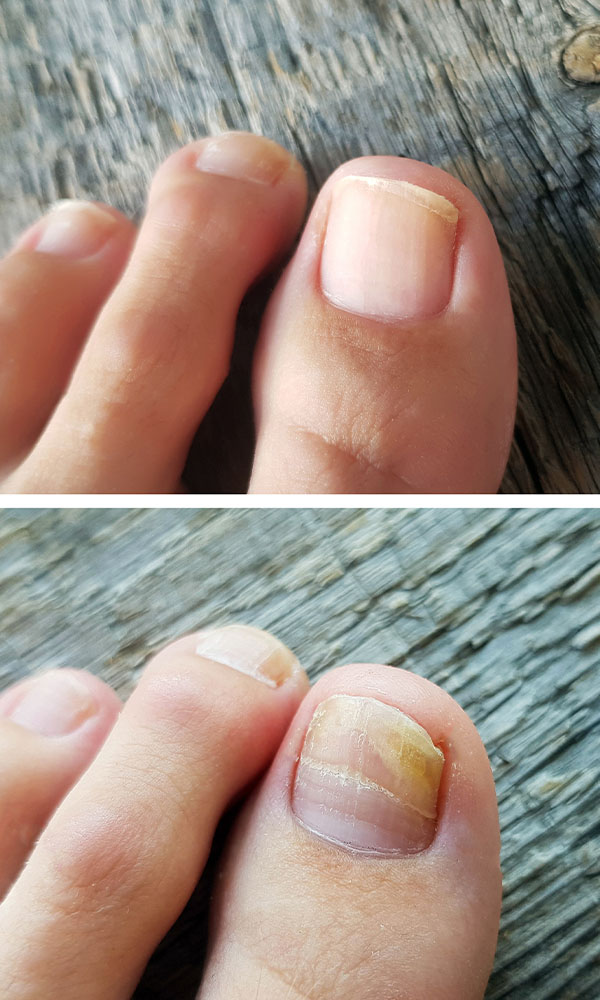 Nail injury at big toe. Toe wound closeup, top view Stock Photo | Adobe  Stock