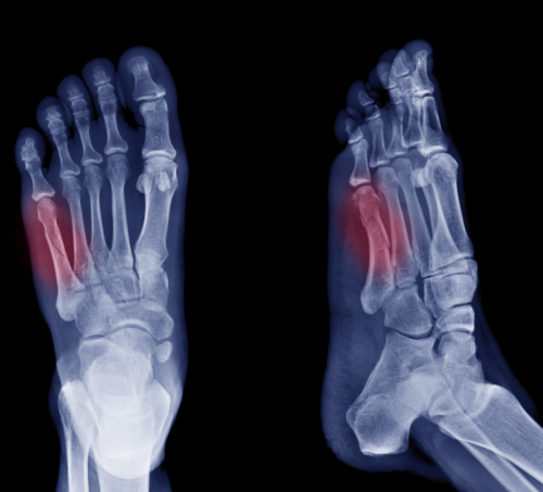 country foot care, feet, jones fracture